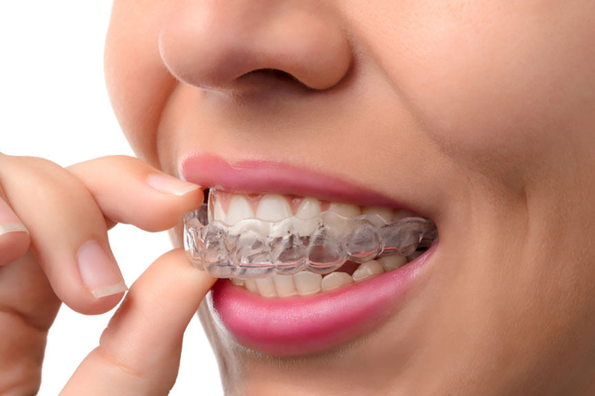 Invisalign Aligners Treatment in Delhi