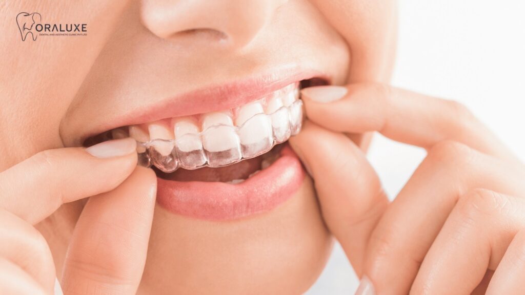 Invisalign Aligners Treatment in Janakpuri