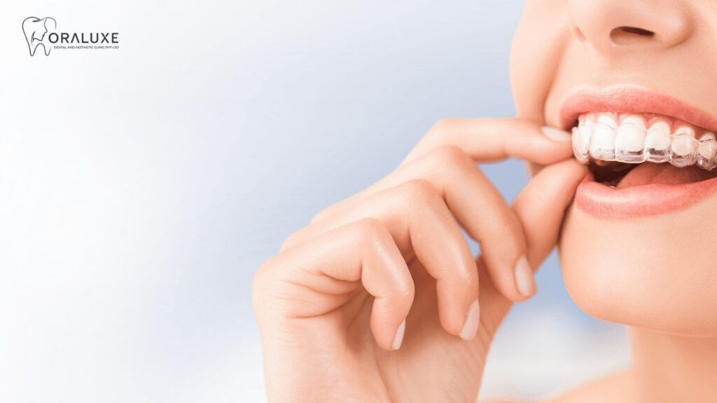Invisalign Aligners Treatment in Janakpuri