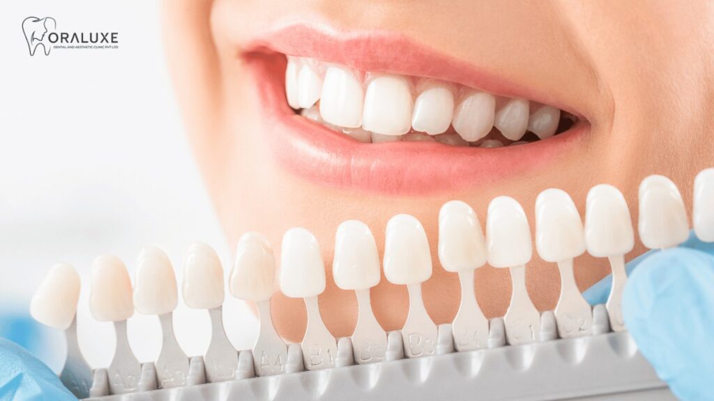 Dental Crown Treatment in Janakpuri