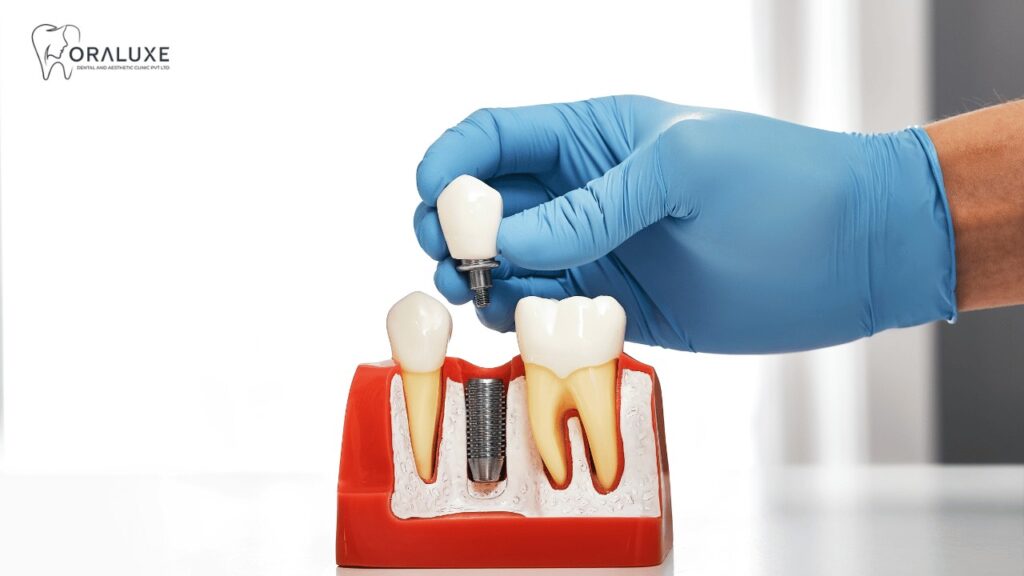 Best Dental Implants Treatment in Janakpuri