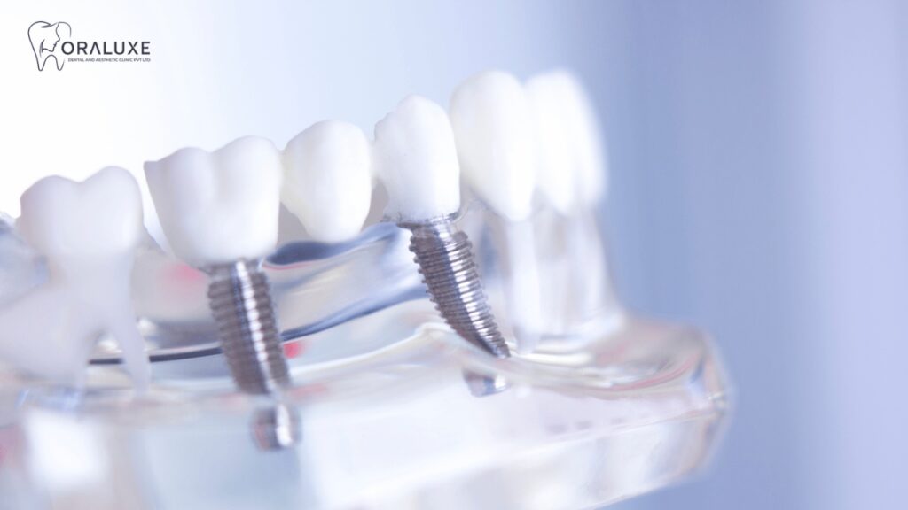 Best Dental Implants Treatment in Janakpuri