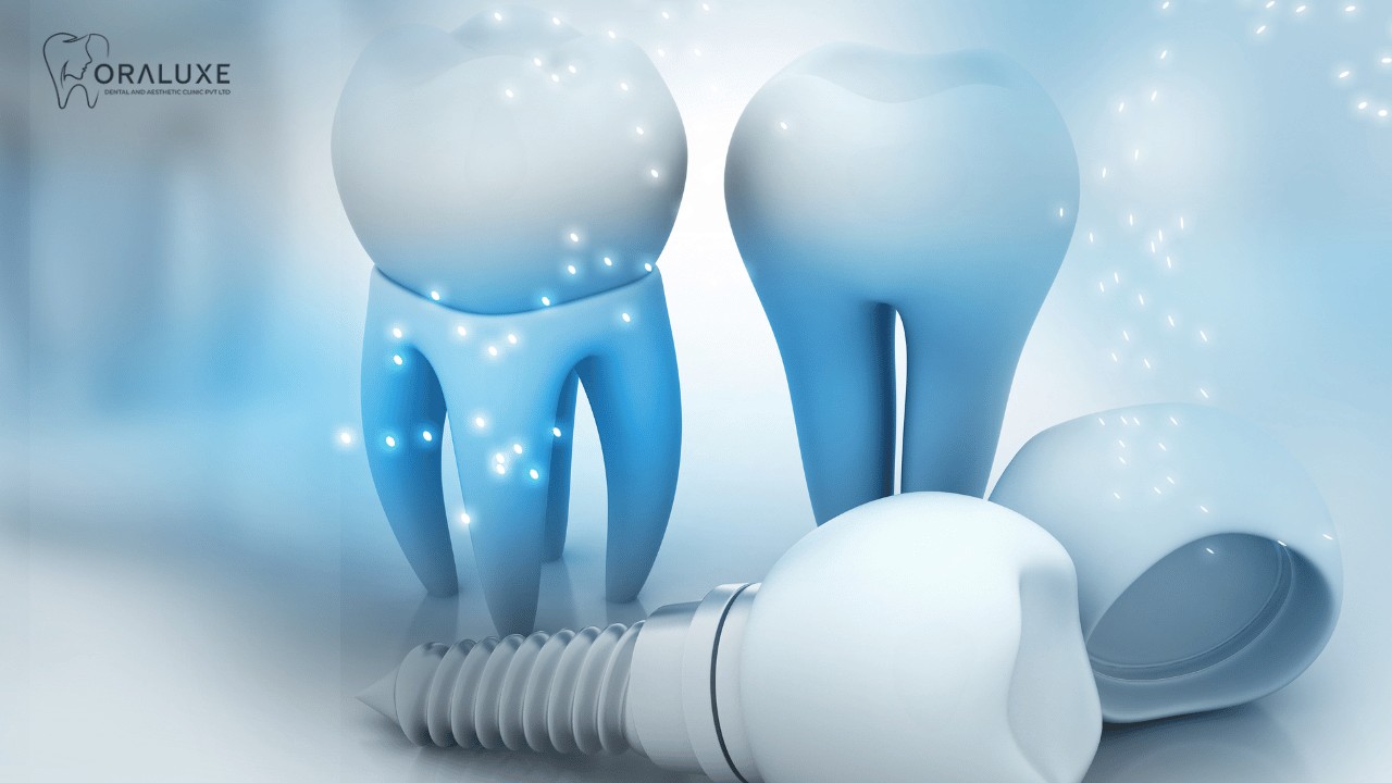 No.1 Dental Implants Treatment in Janakpuri