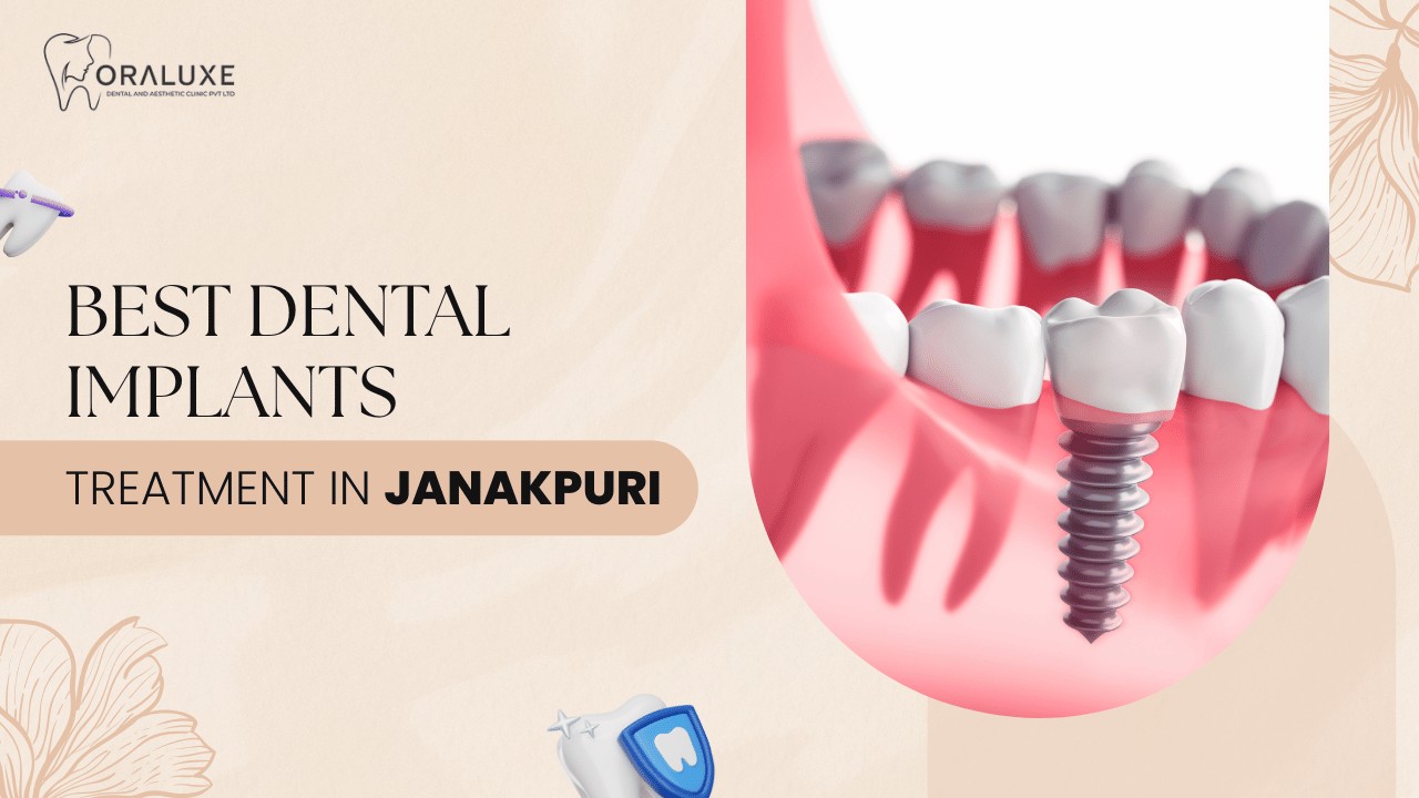 Best Dental Implants Treatment in Janakpuri