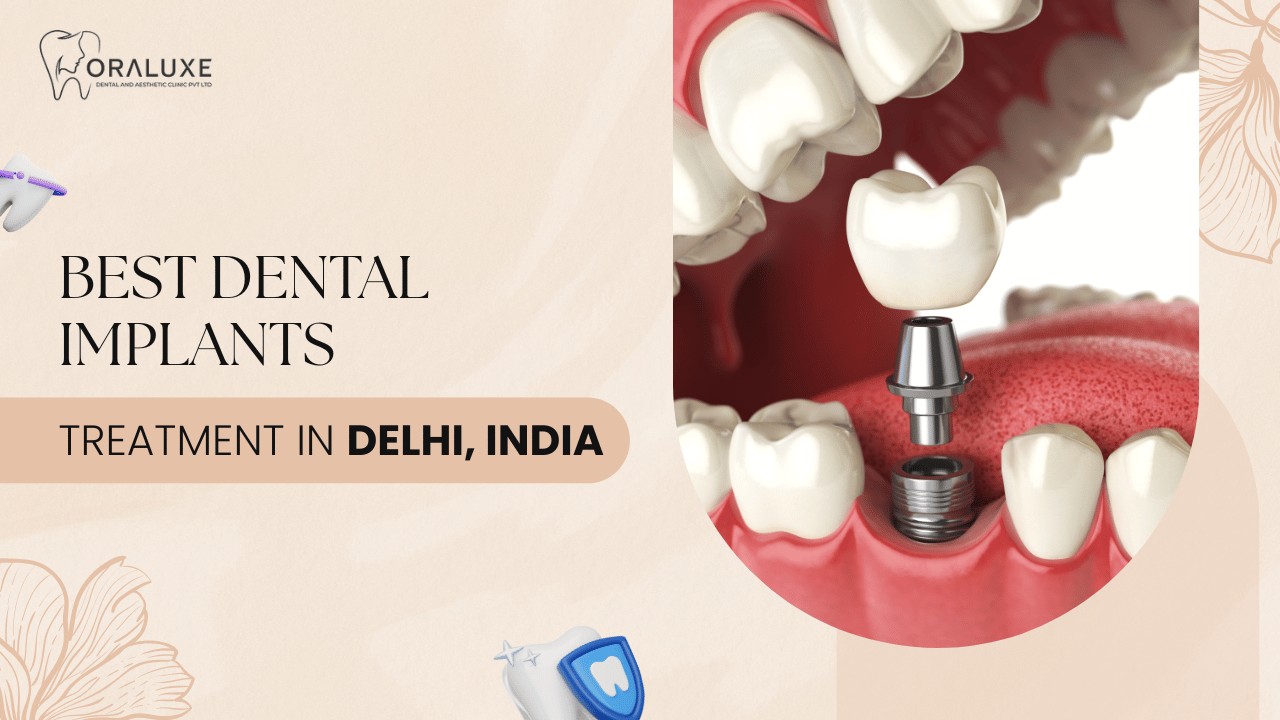 Dental Implants Treatment in Delhi