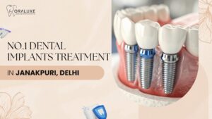 Dental Implants Treatment in Janakpuri