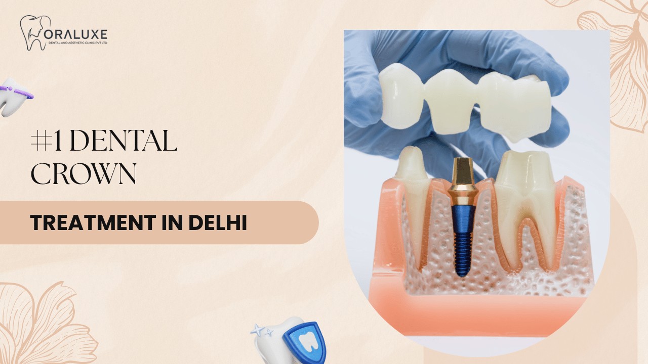 Dental Crown Treatment in Delhi