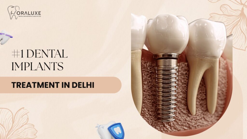 Dental Implants Treatment in Delhi
