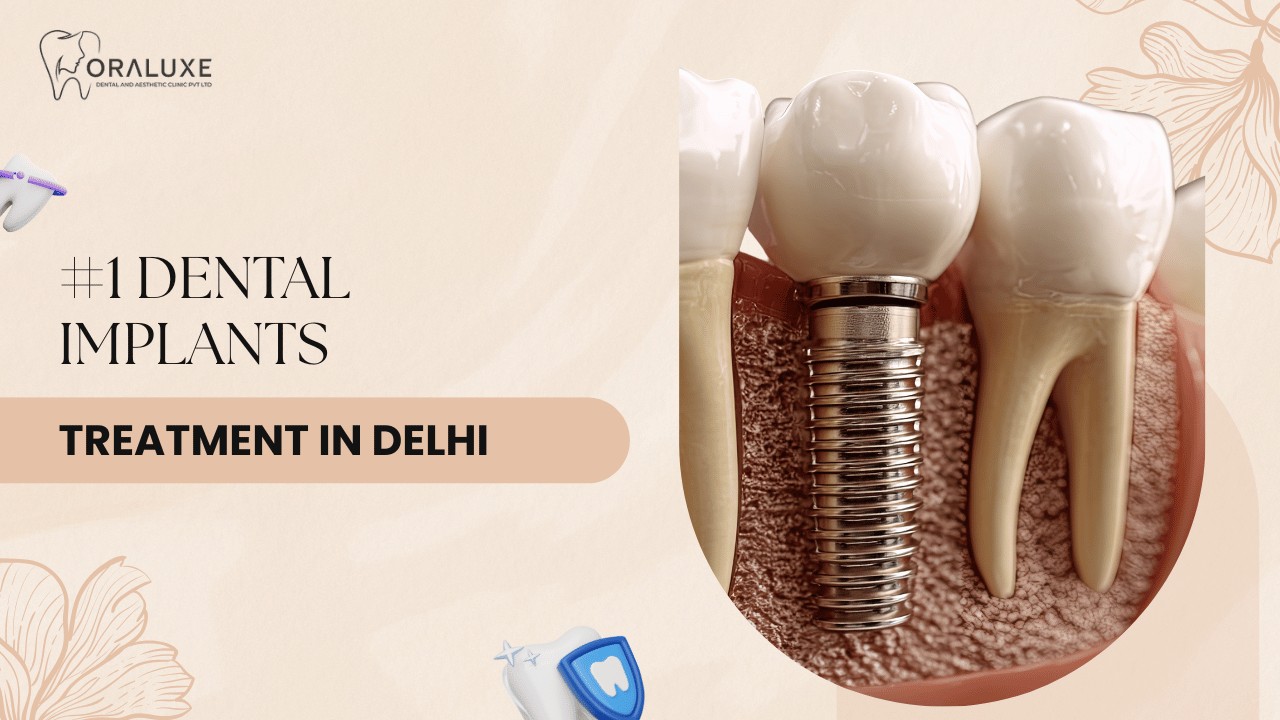 Dental Implants Treatment in Delhi