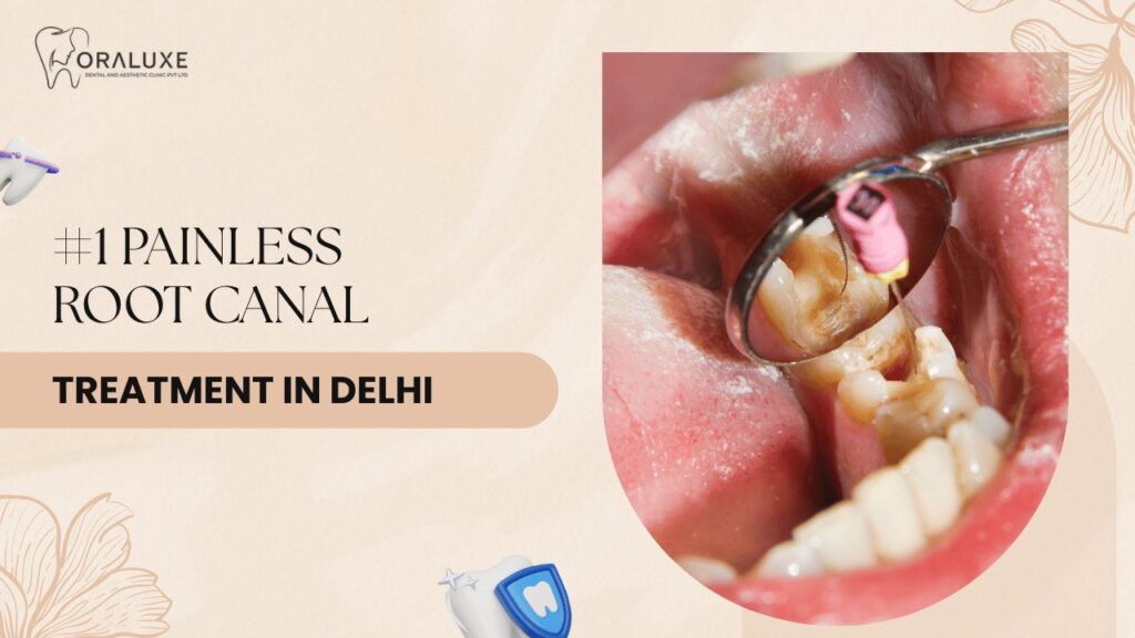 Painless Root Canal Treatment in Delhi