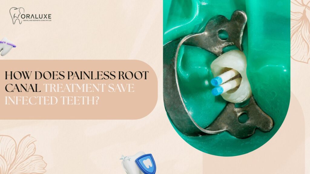 Painless Root Canal Treatment in Delhi