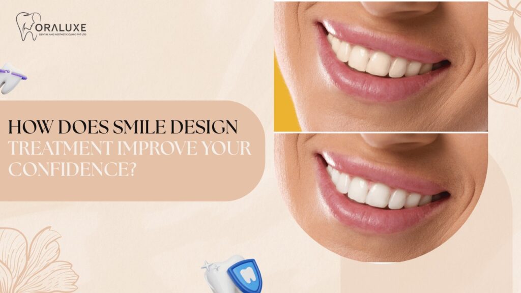 Smile Design Treatment in Delhi