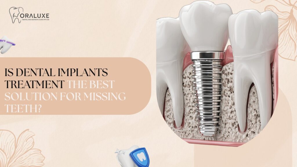Dental Implants Treatment in Delhi