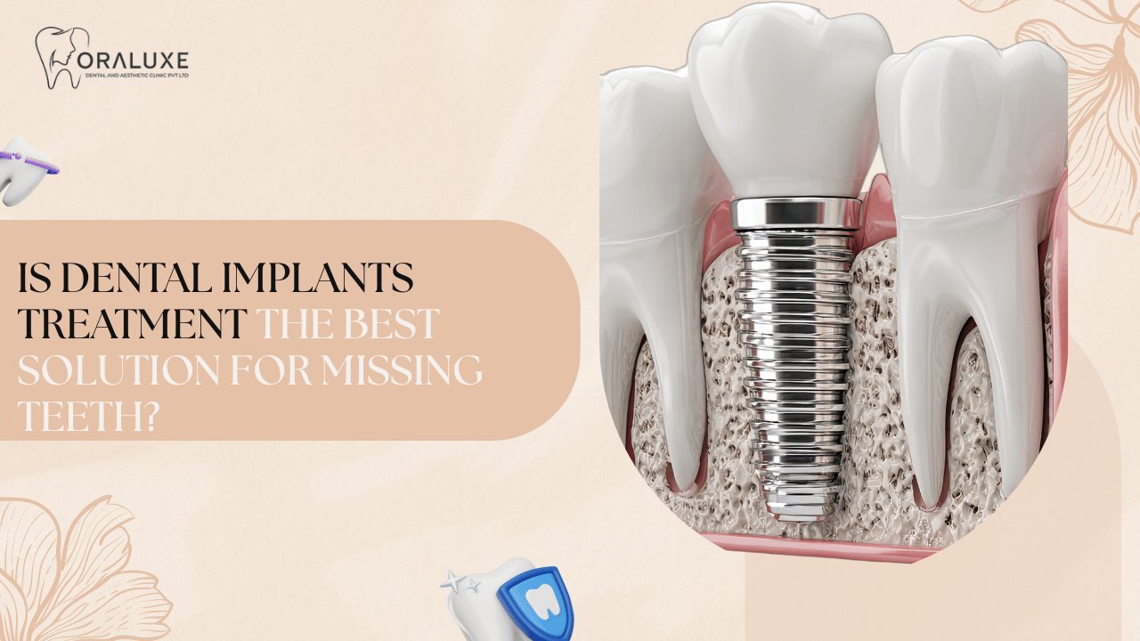 Dental Implants Treatment in Delhi