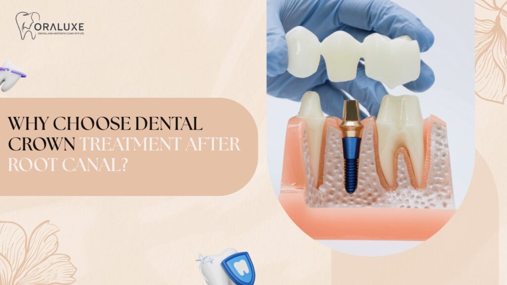 Dental Crown Treatment in Delhi