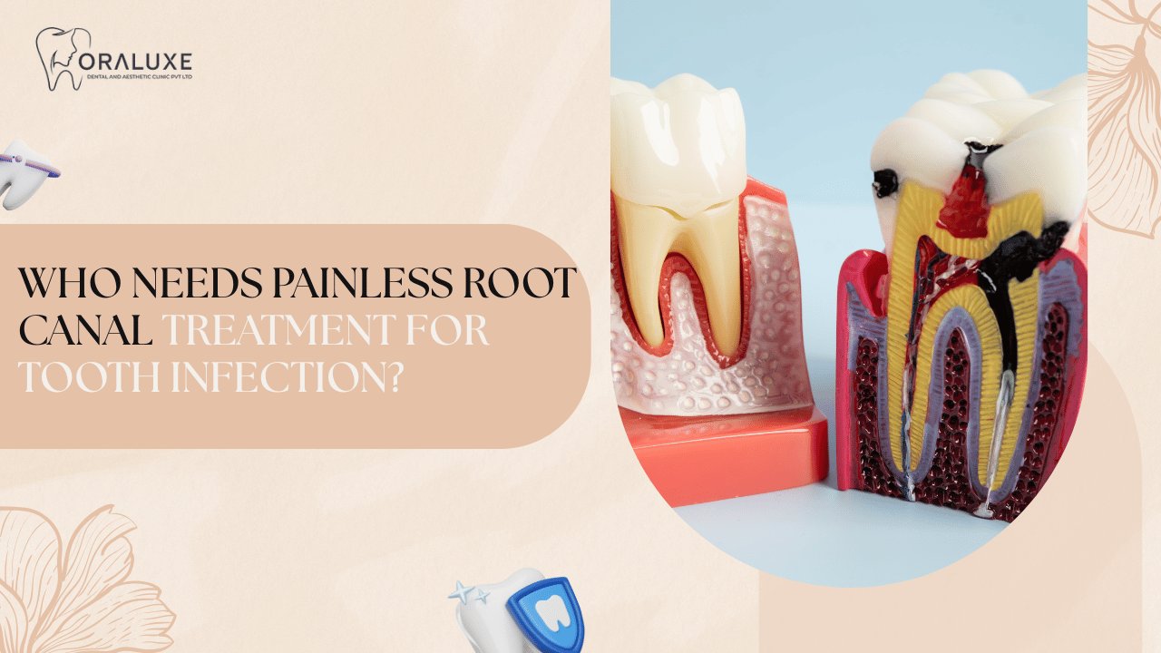 Painless Root Canal Treatment in Delhi