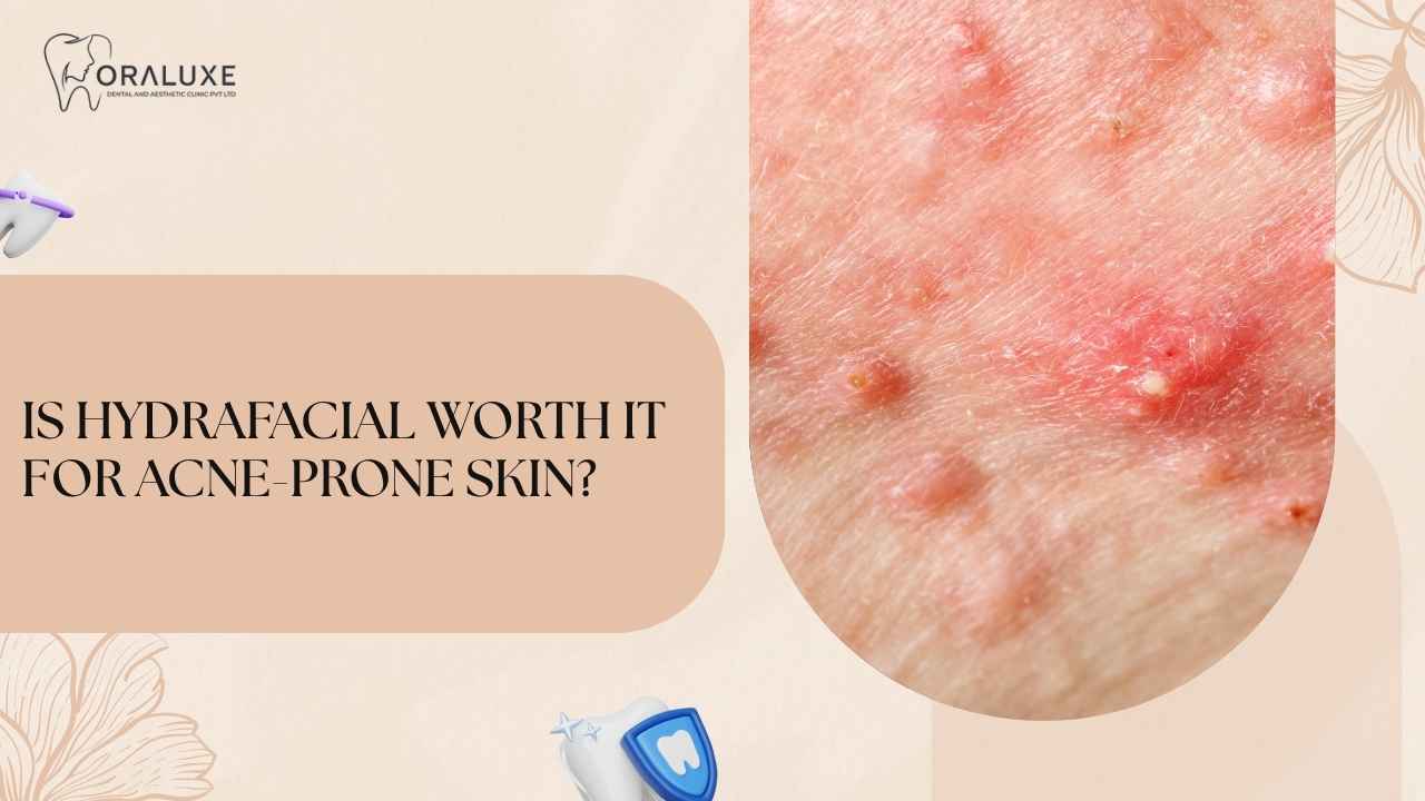 Skin assessment for acne-prone skin before recommending HydraFacial at Oraluxe